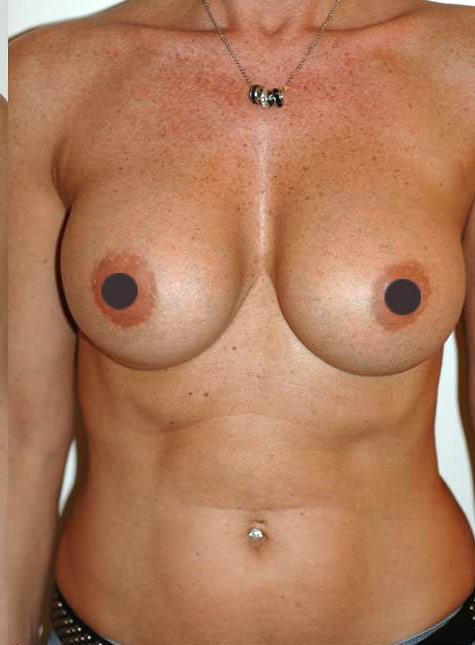 mastoplastica additiva