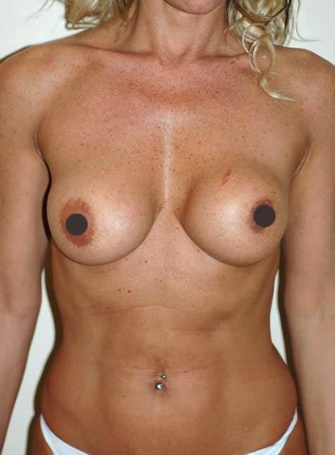 mastoplastica additiva