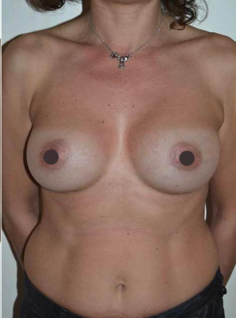 mastoplastica additiva