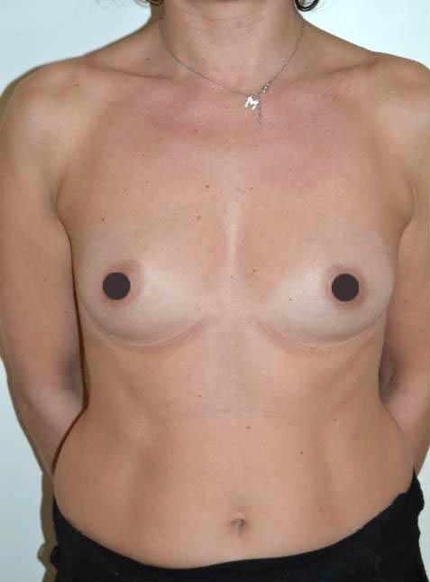 mastoplastica additiva