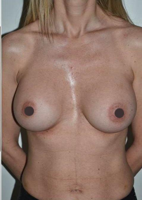 mastoplastica additiva