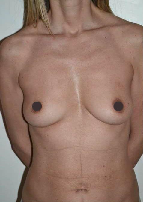 mastoplastica additiva