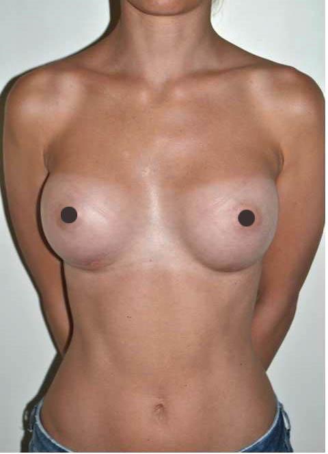 mastoplastica additiva