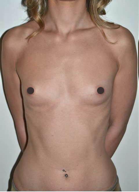 mastoplastica additiva