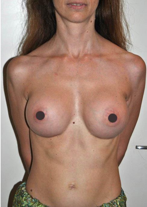 mastoplastica additiva