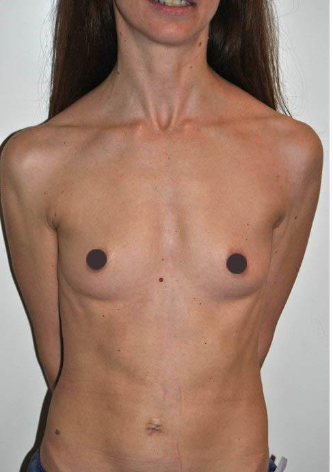 mastoplastica additiva