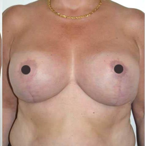 mastoplastica riduttiva