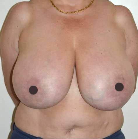 mastoplastica riduttiva