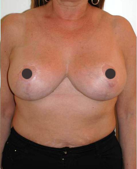 mastoplastica riduttiva