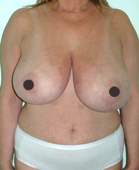 mastoplastica riduttiva