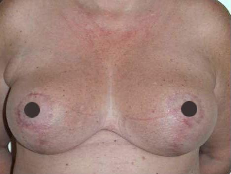 mastoplastica riduttiva