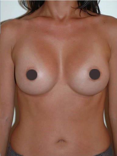 mastoplastica additiva