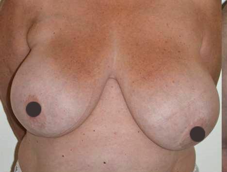 mastoplastica riduttiva