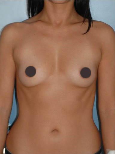 mastoplastica additiva