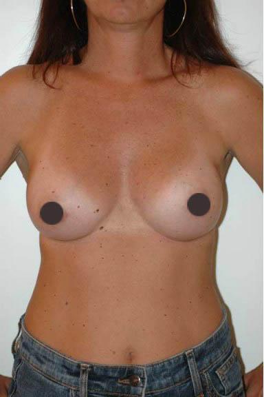 mastoplastica additiva