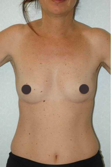 mastoplastica additiva