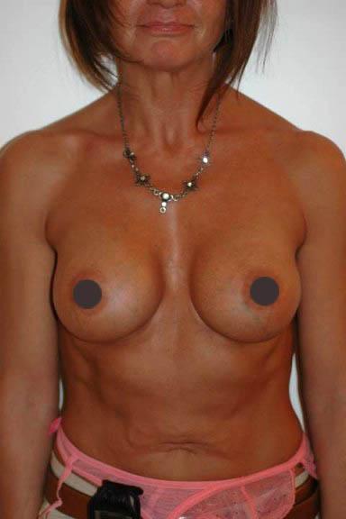 mastoplastica additiva