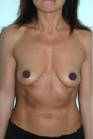 mastoplastica additiva