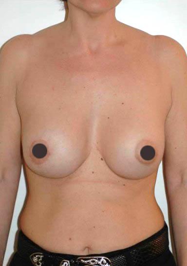 mastoplastica additiva