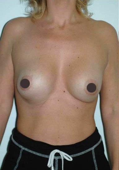 mastoplastica additiva