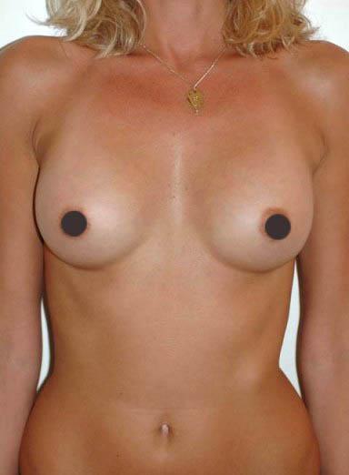 mastoplastica additiva