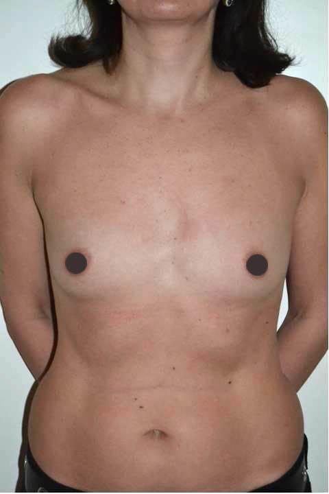 mastoplastica additiva